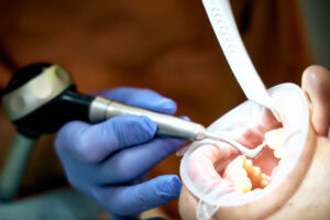 Hochwertiger Zahnarzt in Schwabing für erstklassige Zahnreinigung und Prophylaxe München.